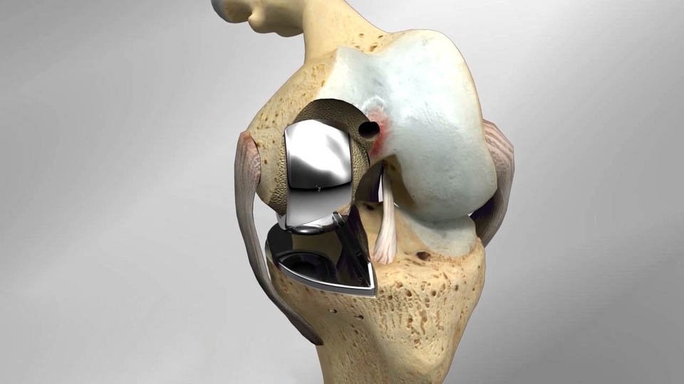 Partial Knee Replacement Ahmedabad