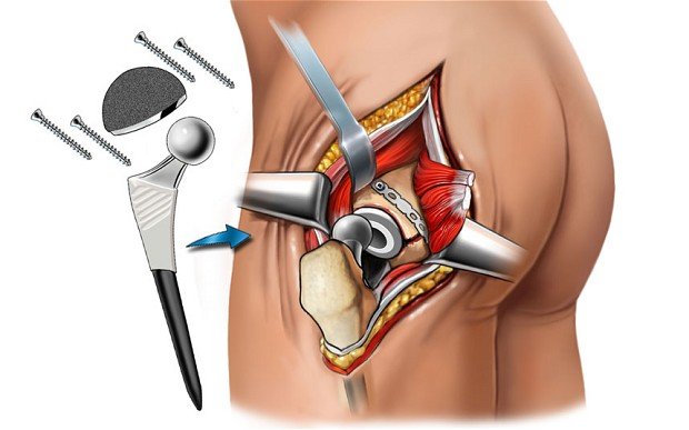 Hip Revision Surgery Gujarat
