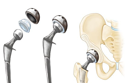 Hip Surgery with Dr. Nevil Gajera